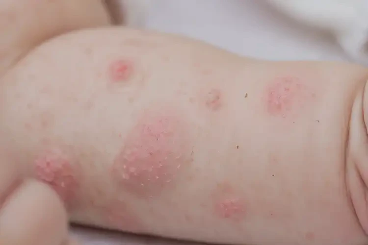 嬰幼兒手臂容易起濕疹能靠自己自愈嗎(圖4)