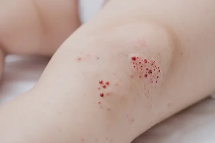 嬰幼兒大腿容易起濕疹能夠徹底治愈嗎(圖4)