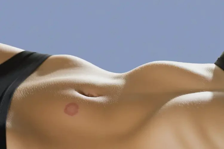 女性肚子上长湿疹可以彻底自愈吗(图1)