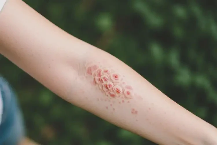 女人身上出濕疹不管它會自己痊愈嗎(圖2)