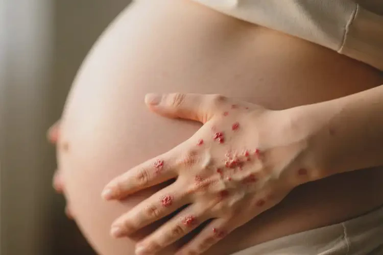 孕婦身上有濕疹不管它會(huì)自己自愈嗎(圖3)