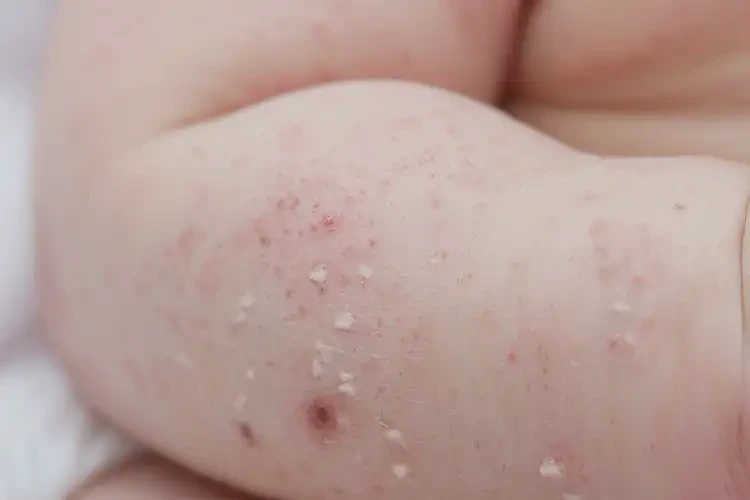 新生兒手臂起濕疹不管它會(huì)自己自愈嗎(圖4)