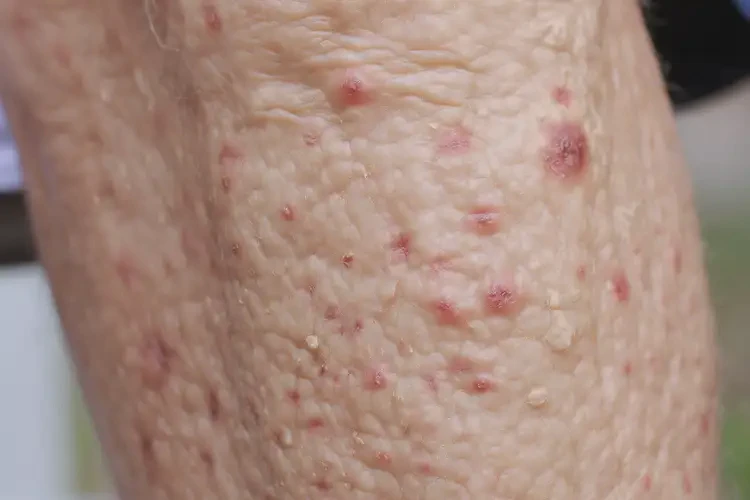 老年人小腿上長(zhǎng)濕疹能夠徹底治愈嗎(圖4)