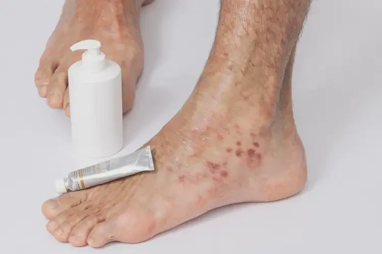 男性腳上偶爾長(zhǎng)濕疹不管它會(huì)自己痊愈嗎(圖1)