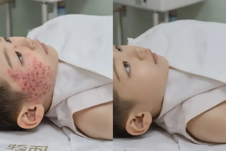 小學生肛周出現(xiàn)濕疹能不能徹底自愈(圖1)