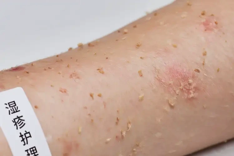 女生手臂起濕疹可以徹底自愈嗎(圖4)