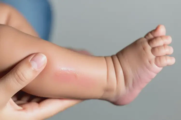 嬰兒小腿出濕疹可以徹底自愈嗎(圖1)