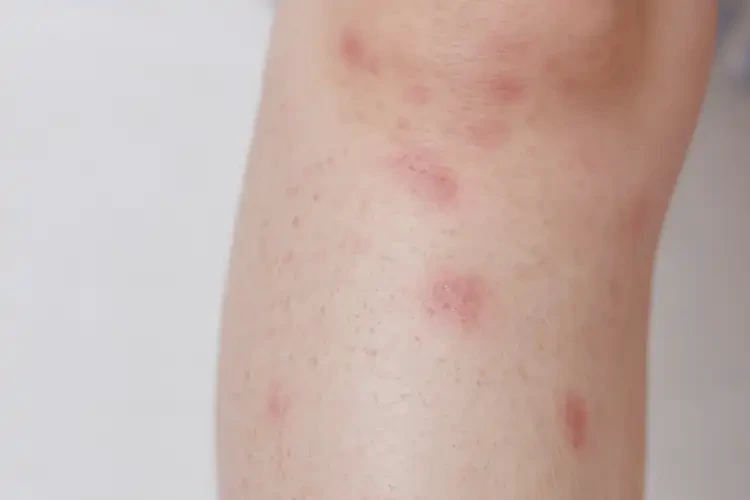 小孩大腿上偶爾長(zhǎng)濕疹不管它會(huì)自己痊愈嗎(圖2)