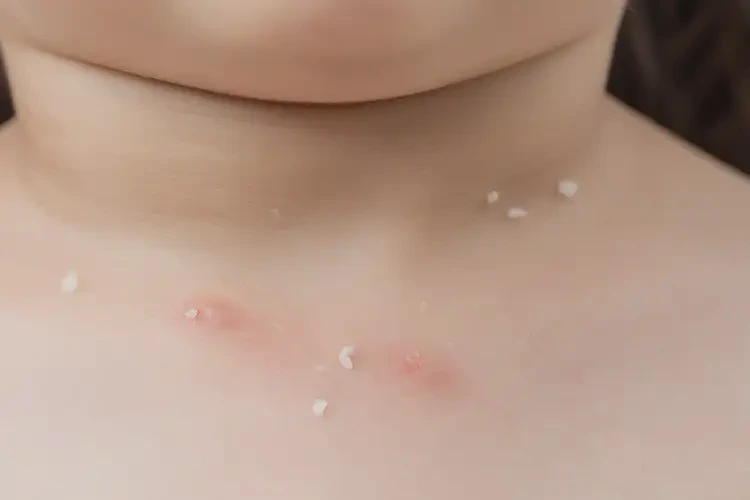 兒童脖子上出現(xiàn)濕疹不管它會自己痊愈嗎(圖4)