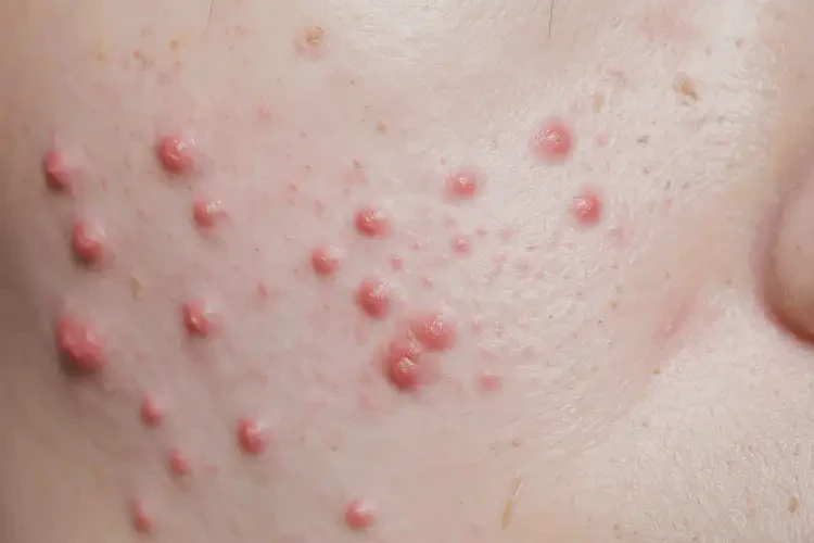 中學(xué)生腳上起濕疹可以徹底自愈嗎(圖4)