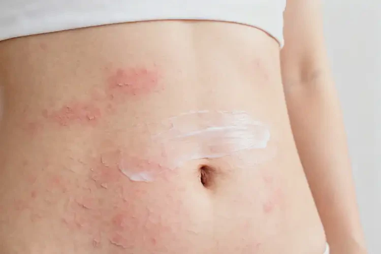 女性肚子长湿疹可不可以彻底自愈(图1)