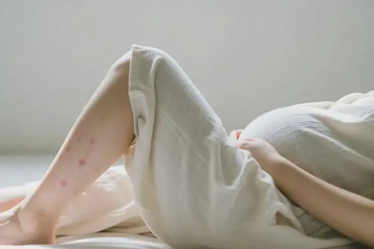 孕婦大腿經(jīng)常起濕疹可不可以徹底自愈(圖3)