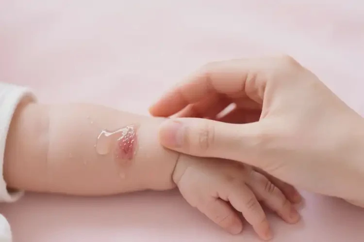 嬰兒手臂容易起濕疹不管它會(huì)自己自愈嗎(圖3)