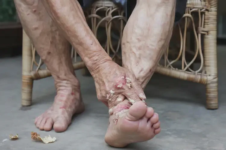高齡老人腳上起濕疹不管它會自己好嗎(圖4)
