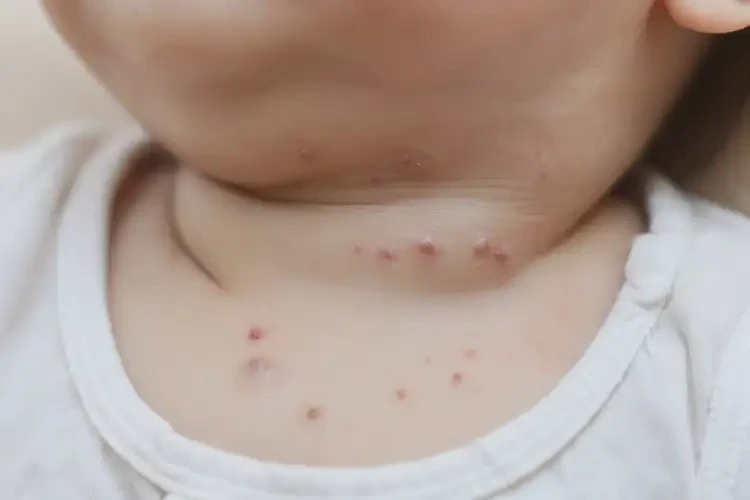 幼兒脖子上偶爾起濕疹不管它會(huì)自己好嗎(圖4)