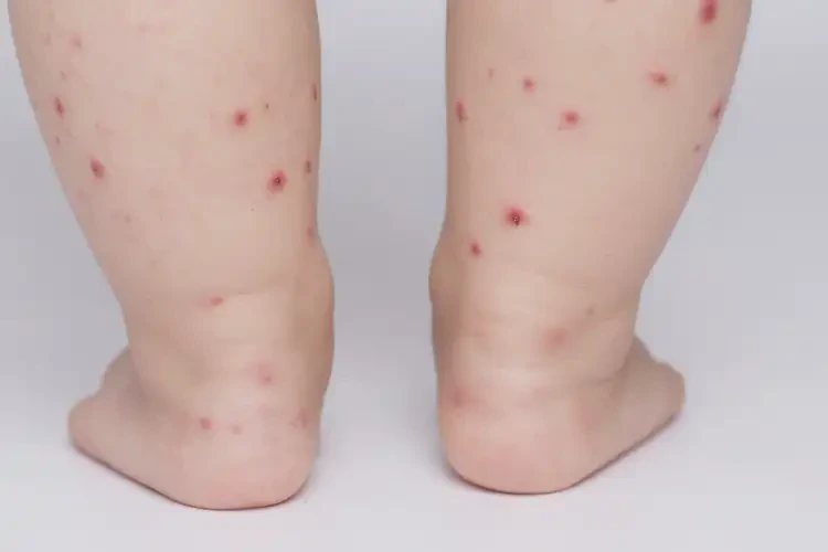 少兒四肢容易長濕疹可不可以徹底自愈(圖4)