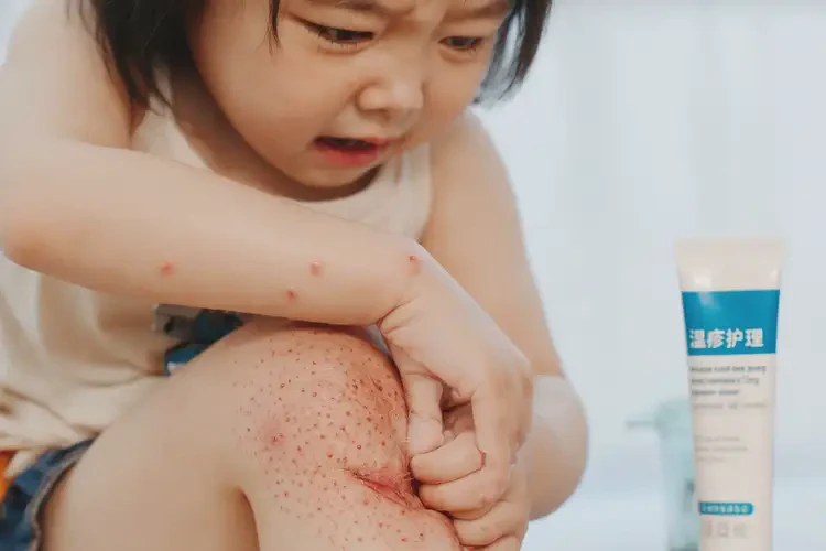 小孩小腿容易起濕疹能徹底自愈嗎(圖4)