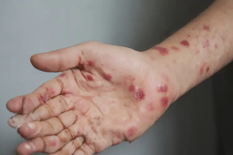 中學(xué)生手上容易起濕疹不管它會自己好嗎(圖3)
