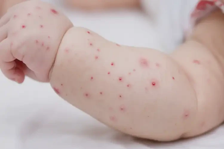 嬰兒手臂有濕疹不管它會(huì)自己痊愈嗎(圖4)