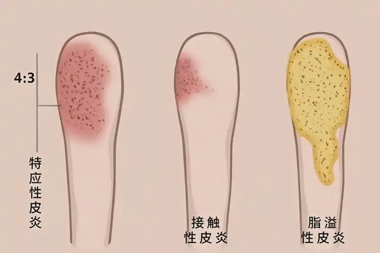 嬰幼兒大腿上經(jīng)常起濕疹能夠徹底治愈嗎(圖4)