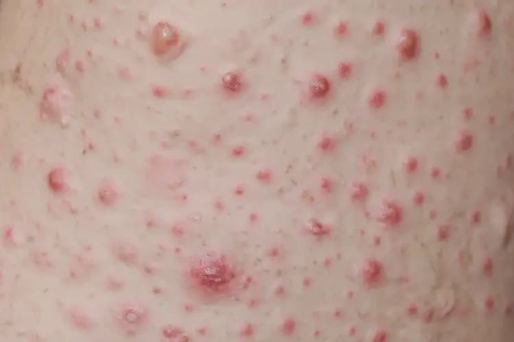 男人全身有濕疹可不可以徹底自愈(圖4)