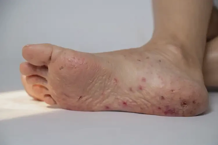 女性腳上出現(xiàn)濕疹能徹底自愈嗎(圖4)