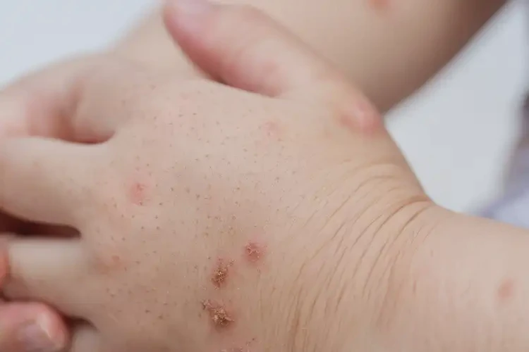 小孩手上容易長(zhǎng)濕疹不管它會(huì)自己痊愈嗎(圖4)