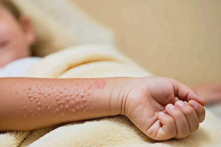 小兒手臂經(jīng)常長(zhǎng)濕疹不管它會(huì)自己好嗎(圖3)