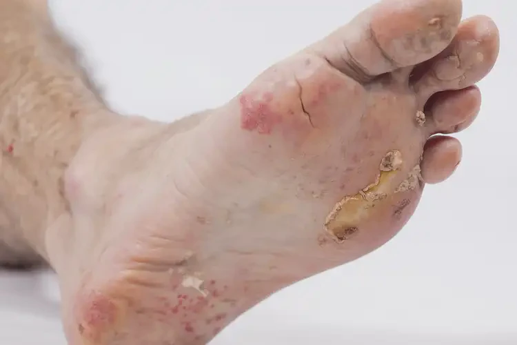 男性腳上偶爾長(zhǎng)濕疹不管它會(huì)自己痊愈嗎(圖2)