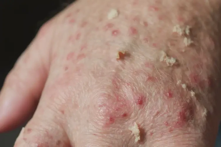 中學(xué)生手上起濕疹不管它會(huì)自己好嗎(圖4)