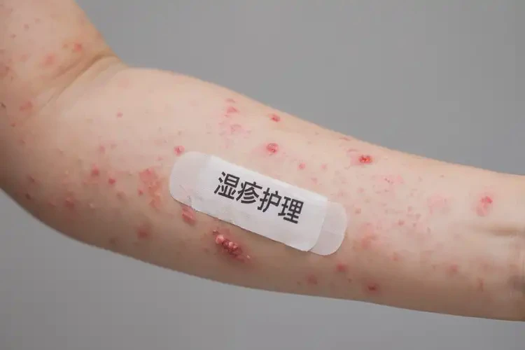小孩手臂上經(jīng)常起濕疹可以徹底自愈嗎(圖4)