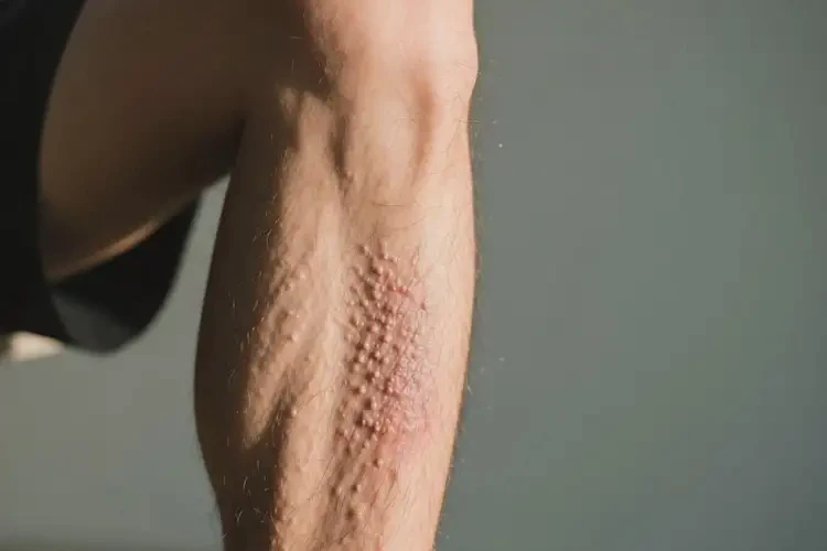 男性小腿上容易長濕疹不管它會自己痊愈嗎(圖3)