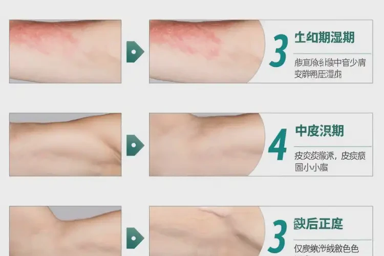 青少年手上偶爾起濕疹可以徹底自愈嗎(圖4)