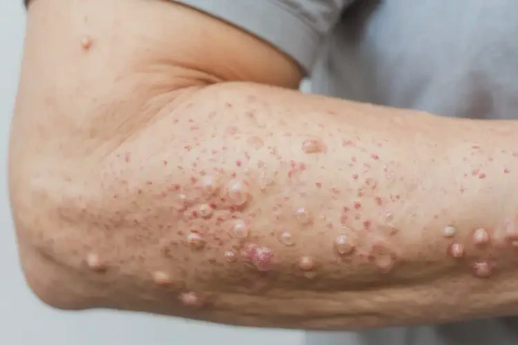 女生手臂經(jīng)常起濕疹不管它會自己好嗎(圖4)