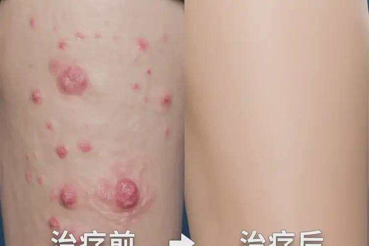 少兒大腿出現(xiàn)濕疹能夠徹底治愈嗎(圖4)