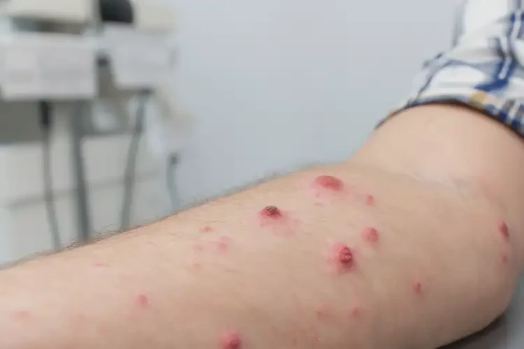 男人手臂上偶爾起濕疹不管它會(huì)自己自愈嗎(圖4)