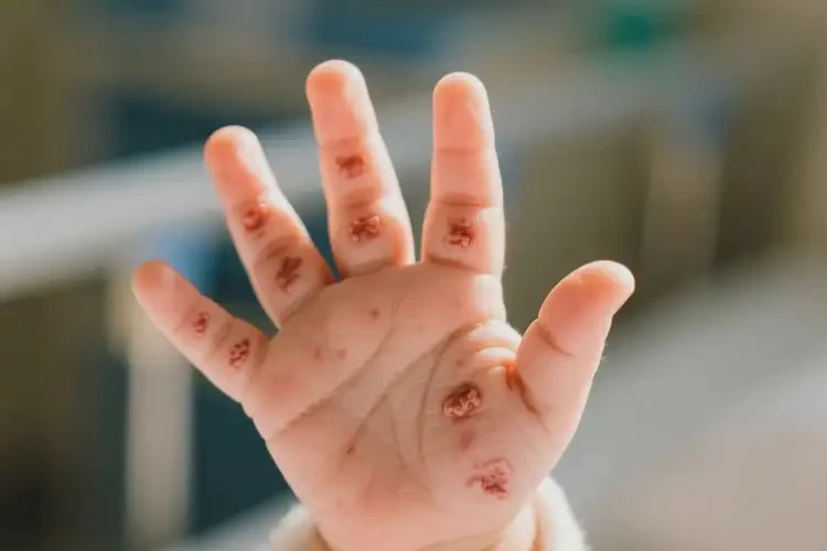 寶寶四肢起濕疹不管它會(huì)自己痊愈嗎(圖4)