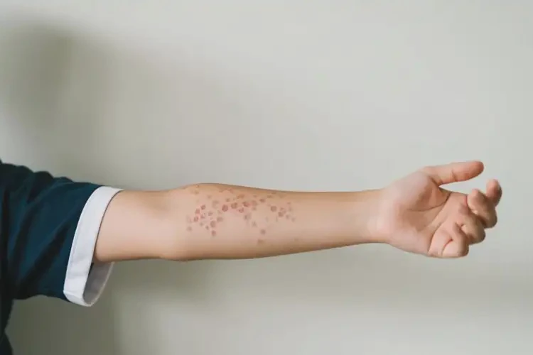 中學(xué)生手臂上起濕疹能徹底自愈嗎(圖3)