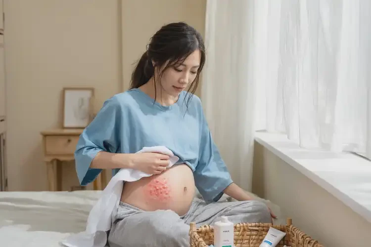 哺乳期媽媽肚子上容易起濕疹可不可以徹底自愈(圖2)