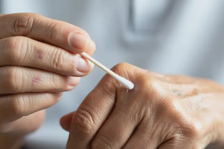 高龄老人手上偶尔长湿疹能彻底自愈吗(图1)