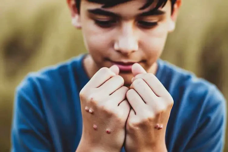 青少年手上有濕疹能靠自己自愈嗎(圖1)