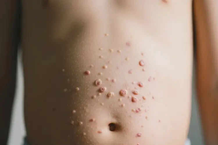 小孩肚子容易長(zhǎng)濕疹能夠徹底治愈嗎(圖3)