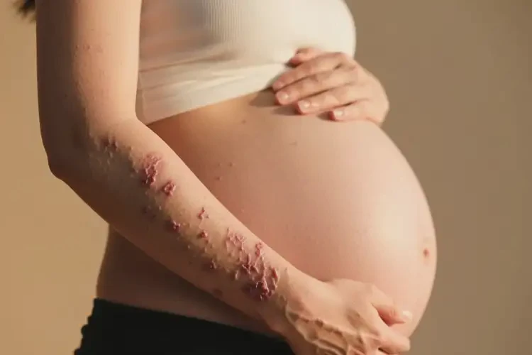 孕妇手臂上有湿疹可不可以彻底自愈(图1)