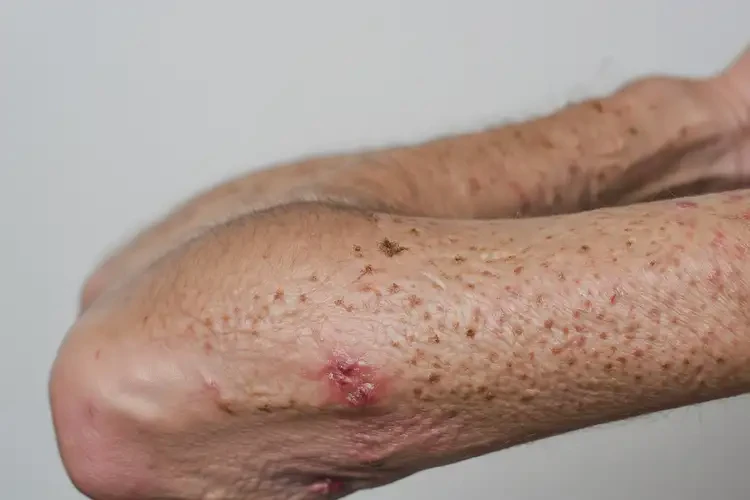 女生手臂上起濕疹可不可以徹底自愈(圖2)