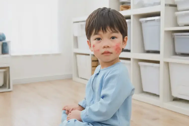 小孩全身長濕疹能徹底自愈嗎(圖1)