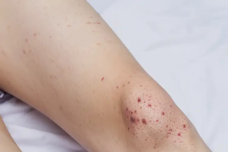 青少年大腿經(jīng)常起濕疹可以徹底自愈嗎(圖3)