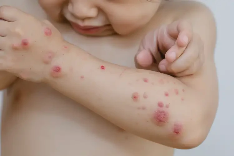 少兒身上起濕疹可以徹底自愈嗎(圖4)