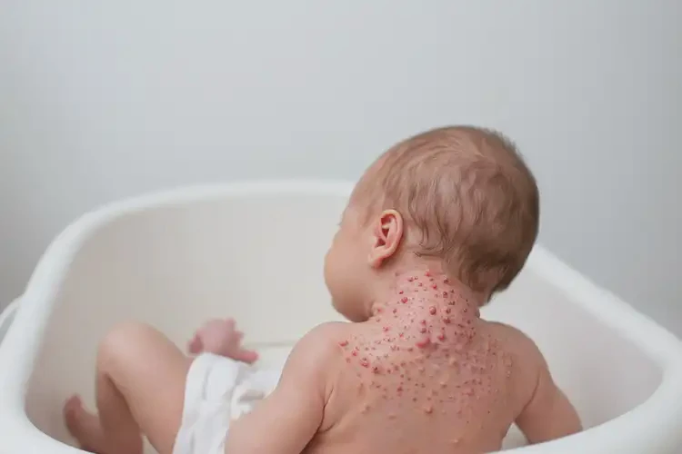 新生兒脖子長(zhǎng)濕疹不管它會(huì)自己自愈嗎(圖4)