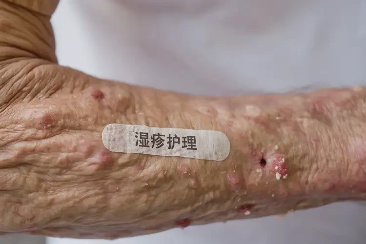 老人手臂偶爾長(zhǎng)濕疹不管它會(huì)自己自愈嗎(圖4)