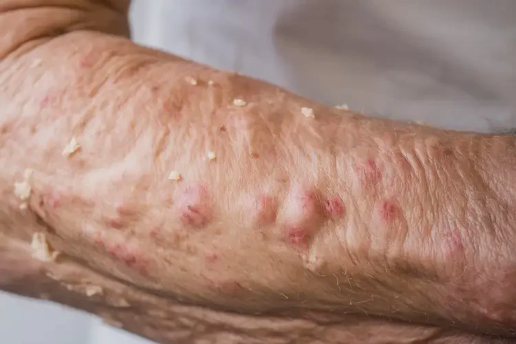 老年人脖子上长湿疹能彻底自愈吗(图4)